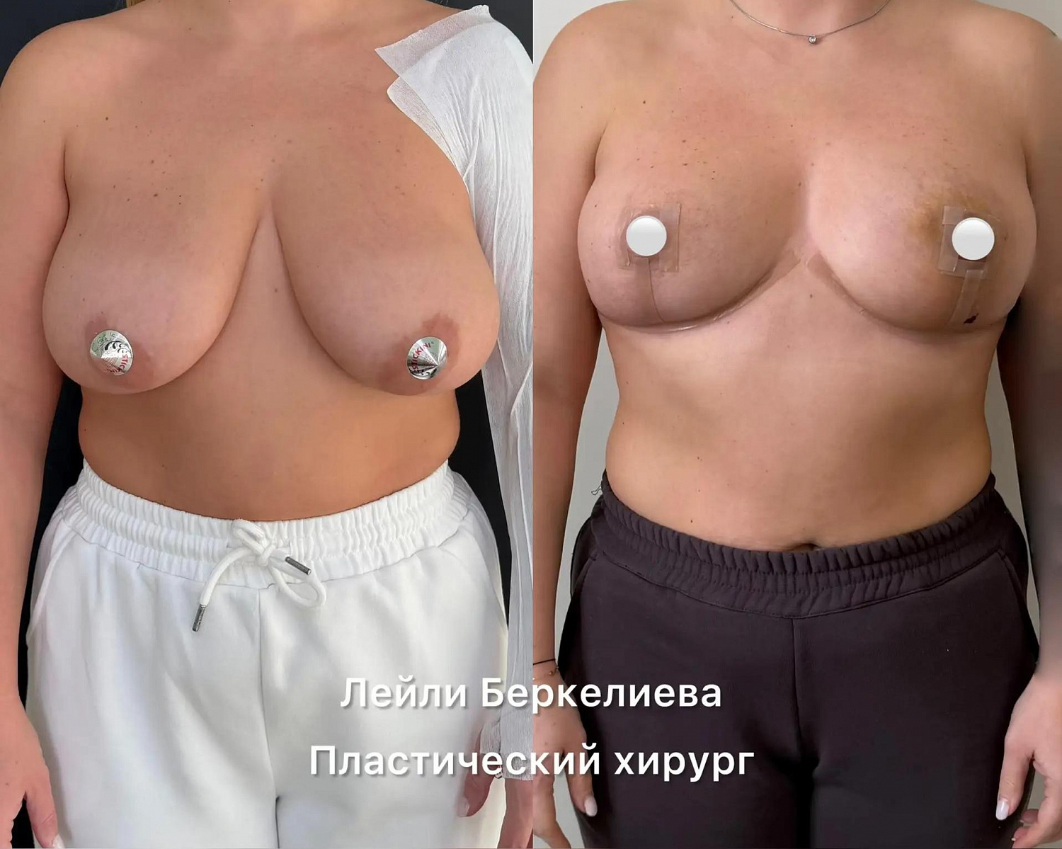 Пластика груди