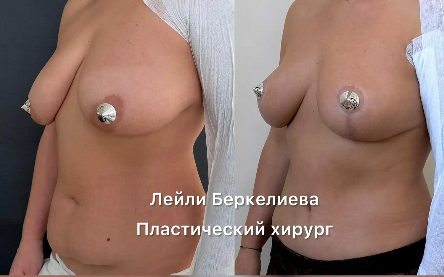 Пластика груди