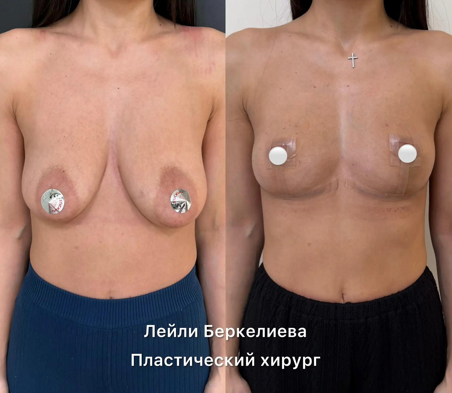Пластика груди