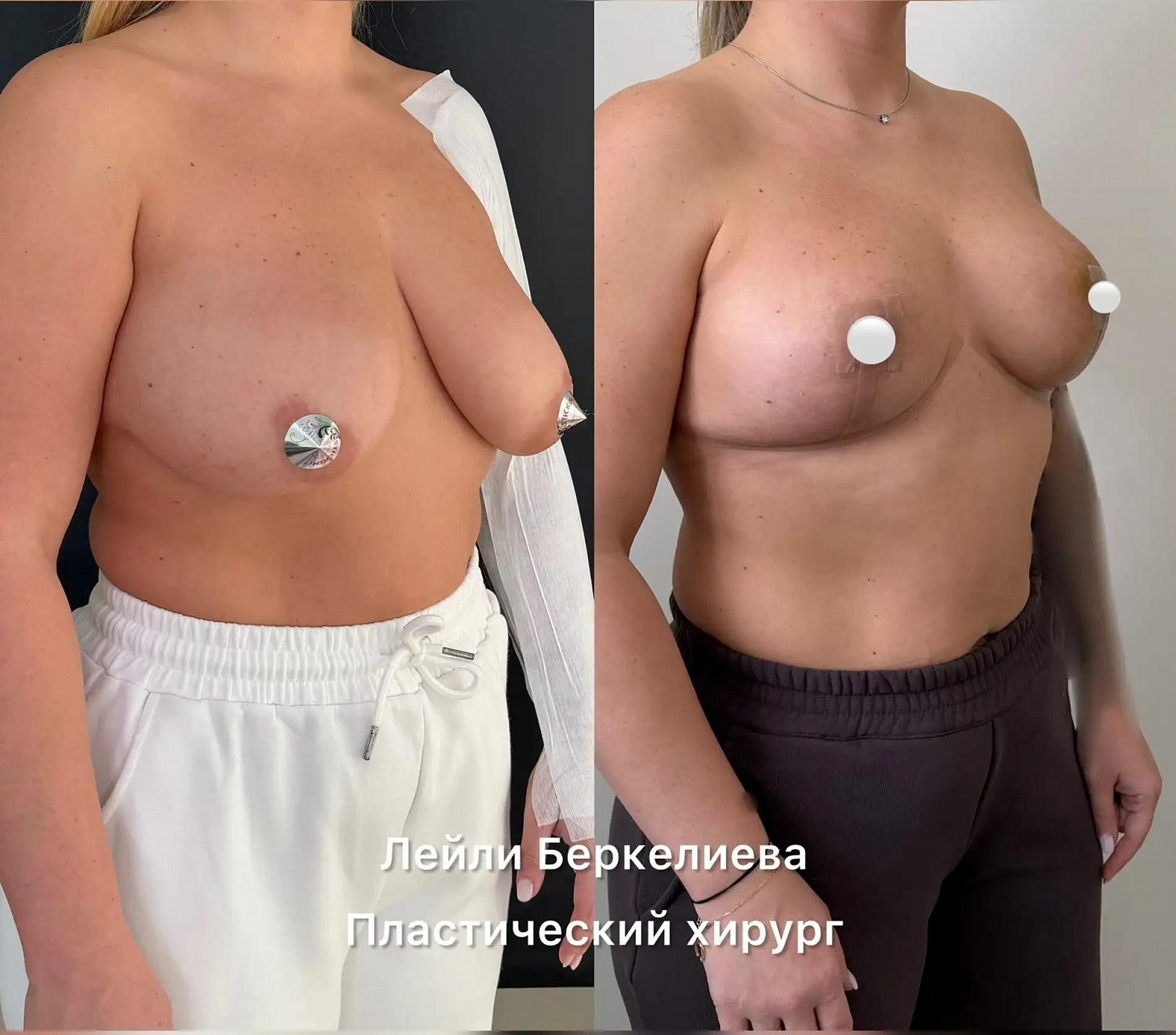 Пластика груди