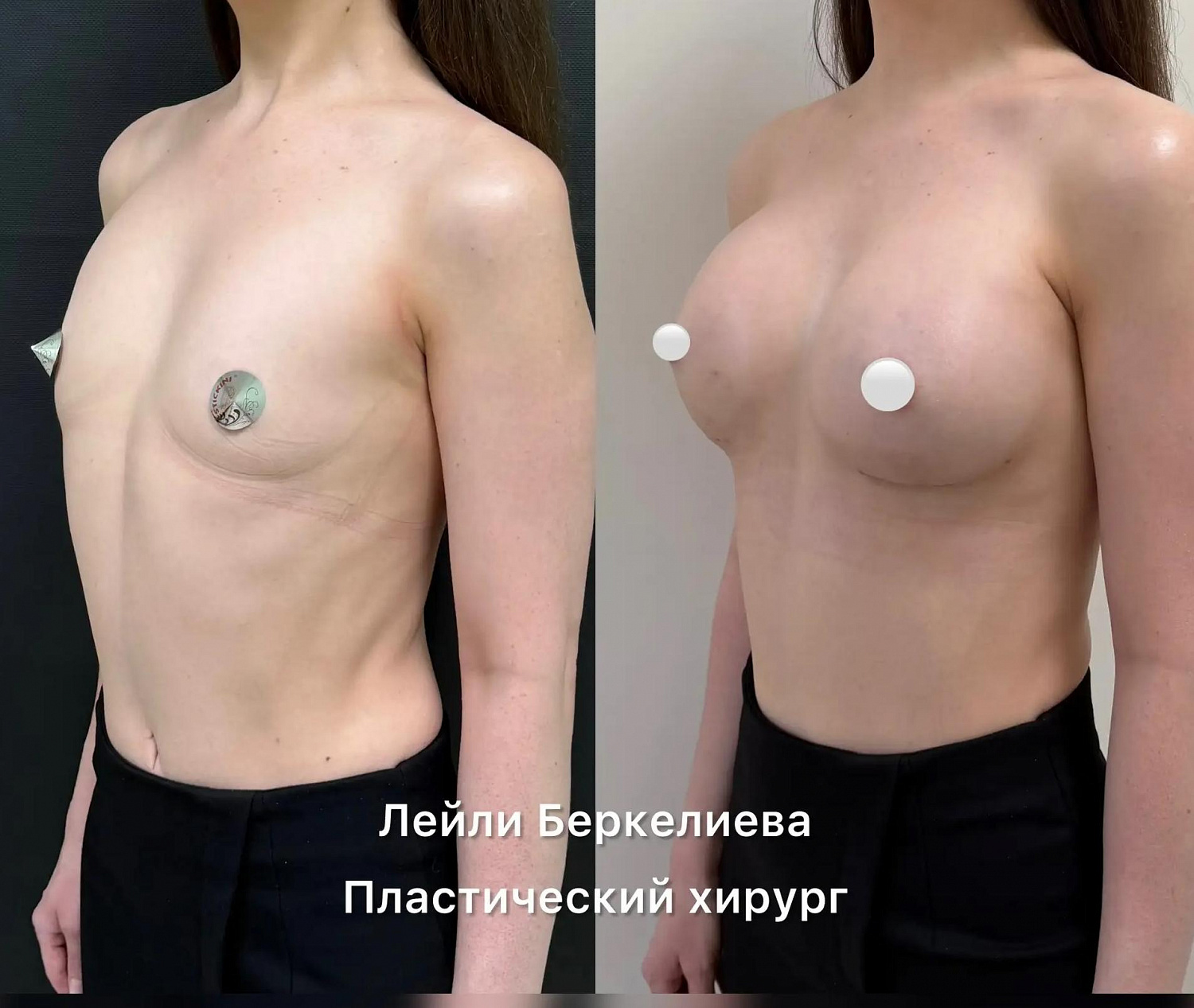 Пластика груди