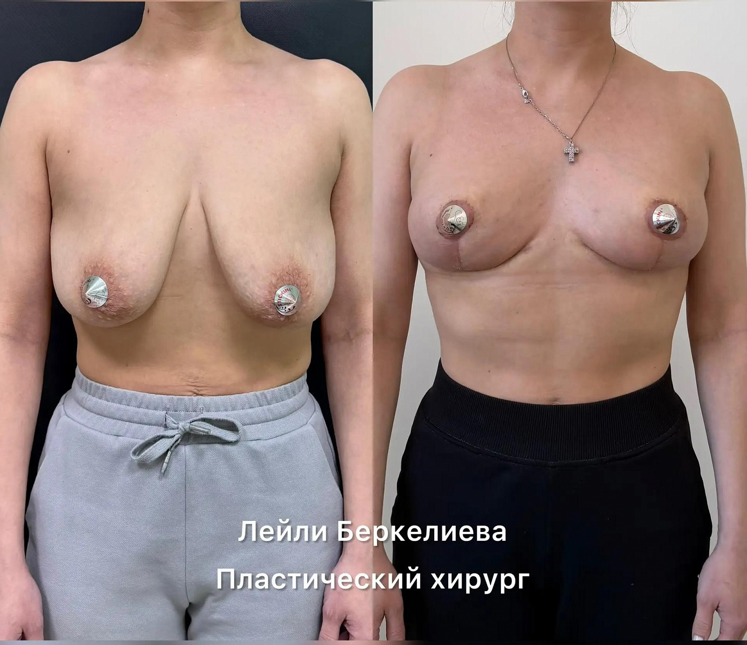 Маммопластика (пластика молочных желез).
