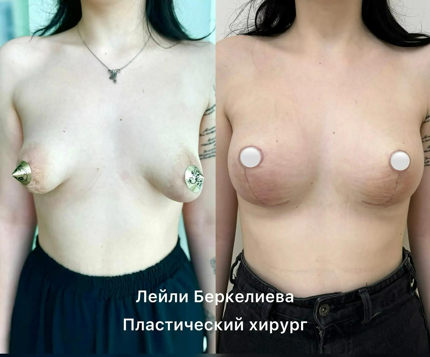 Пластика груди